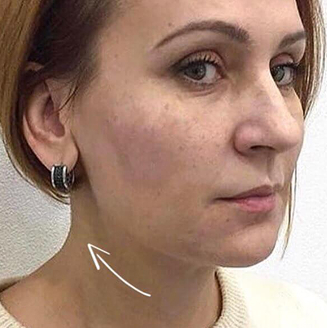 Face transformation after